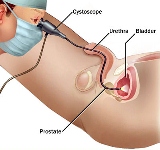 Cystoscopy Facility in Purnea